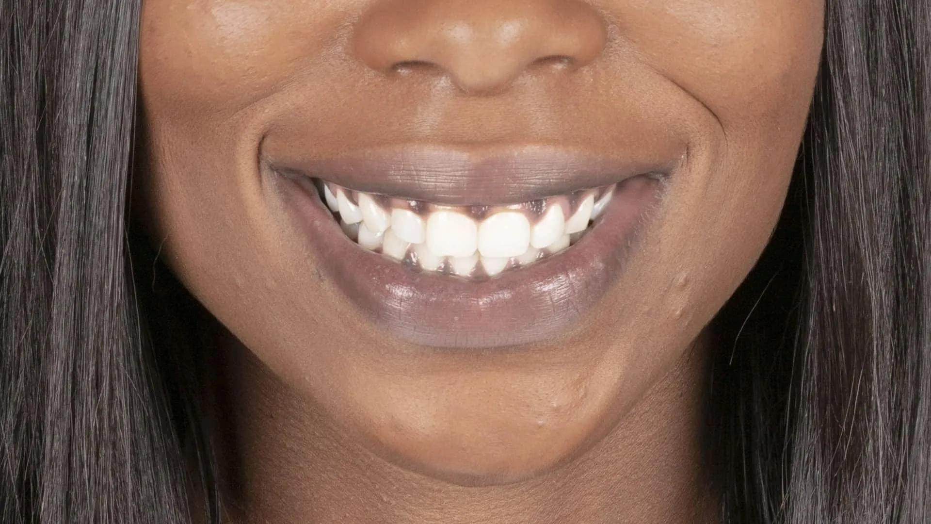 black gums from chewing tobacco Black Gums: Causes, Symptoms, and Treatments